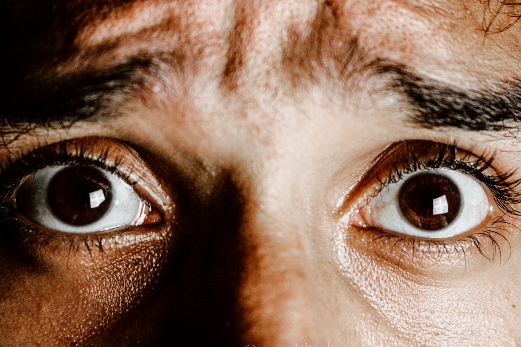 A close-up of a person’s eyes shows a stressed expression. This could symbolize the stress an EMDR therapist in Palm Beach, FL can help address. Learn more about EMDR in Palm Beach, FL and other services today. 